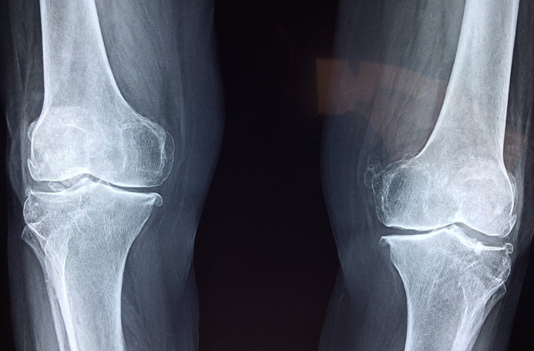 Arthritis