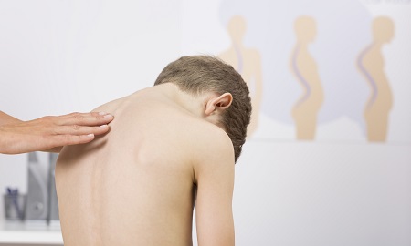 Scheuermann’s Disease